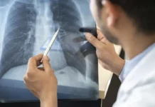 Anvisa aprova novo medicamento para câncer de pulmão avançado Brasília - 06/08/2026 - O Agosto Branco, campanha dedicada à conscientização sobre o câncer de pulmão. Foto- Divulgação
